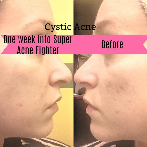 Super Acne Fighter / Organic Acne Treatment / Acne - Walmarkettt.com